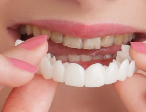 لمینت متحرک | با روش کم‌هزینه و بدون نیاز به جراحی زیبایی دندان آشنا شوید
