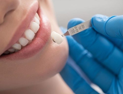 عوارض لمینت دندان ، نکات مهمی که قبل از لمینت باید بدانید